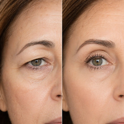 Lumonix™ Eyelid Corrective Strips